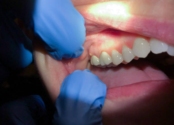 Best Emergency Root Canal Treatment in Tawas City, MI